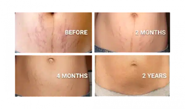 کرم رفع ترک بدن 3 در 1 موستلا mustela - Image 3